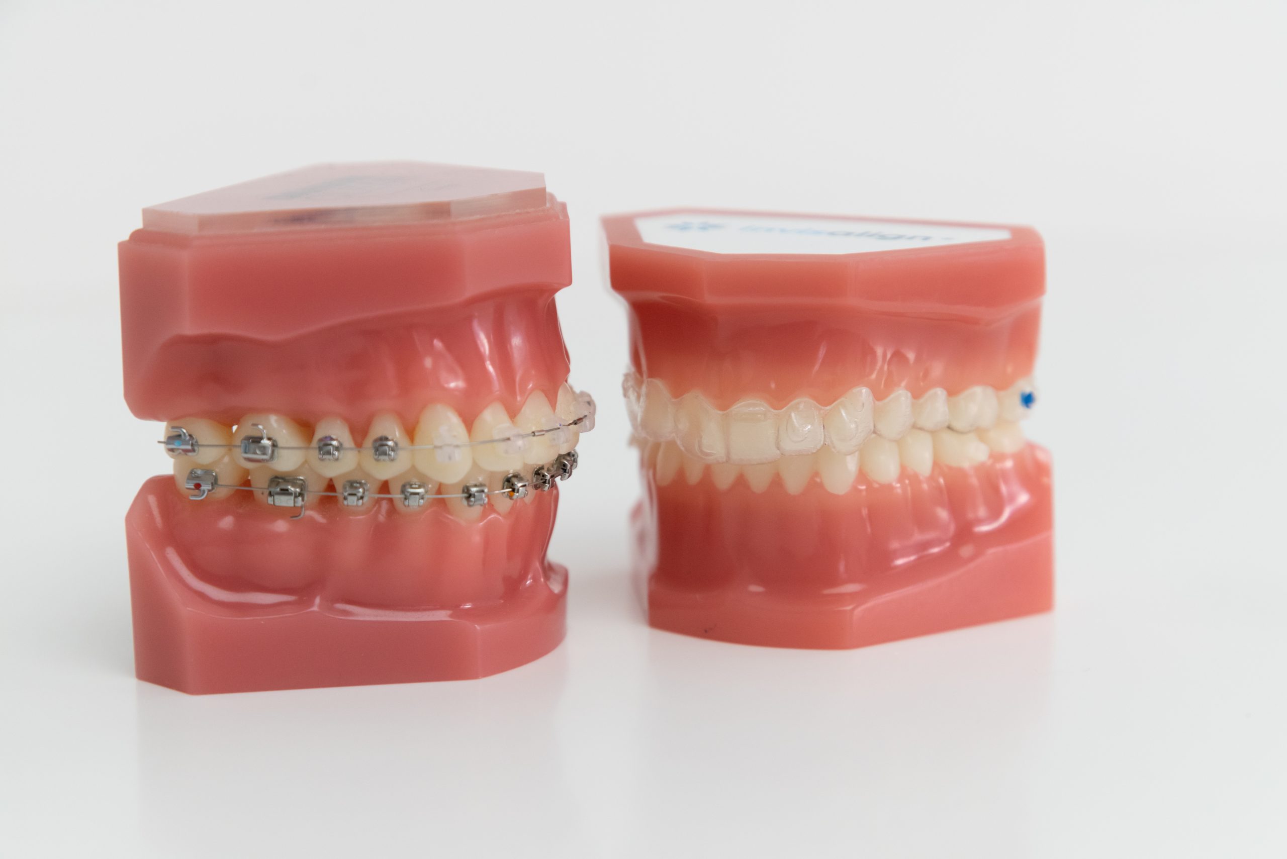 Orthodontie et mini-vis / Dr Eric Ursat Strasbourg 